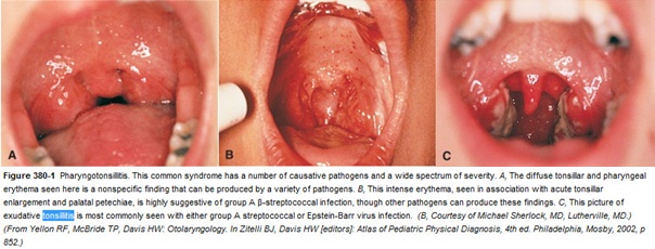 Tonsils In Children Causes, Features, Diagnosis, Treatment ...