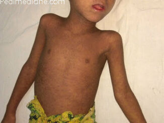 Measles Symptoms Pictures Vaccination Immunization and Prevention (2)
