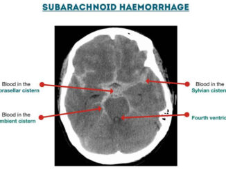 Subarachnoid Haemorrhage cisterns