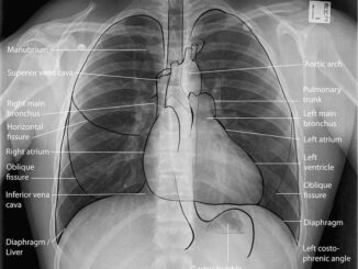 Understandings Basics and How To Read Chest Xray
