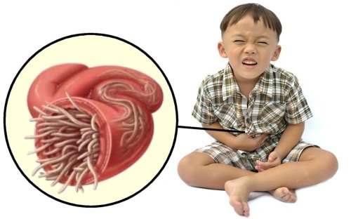 Parasite infection in children