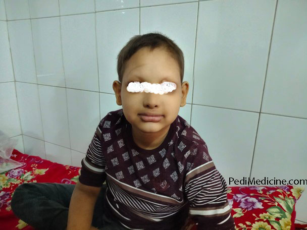 Ectodermal-dysplasia child