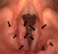 What is laryngeal papilloma Papillomatosis symptoms