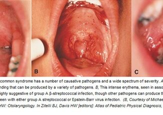 bacterial infection in tonsils